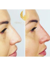 Non-Surgical Nose Job - Feonix Aesthetics