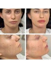 Chin Fillers - Skinderm