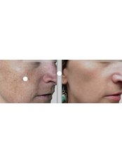 Pigmentation Treatment - The Laser Room Coventry
