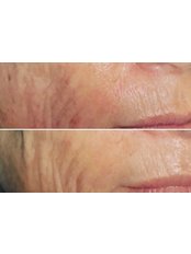 Radiofrequency Skin Tightening - The Laser Room Coventry