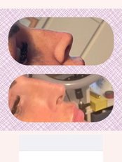 Non-Surgical Nose Job - Aesthetics by Paula Mckervey