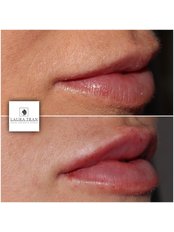 Lip Filler - Laura Tran Facial Aesthetic Studio