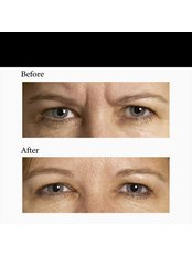Botox™ - Spa Laser and Beauty