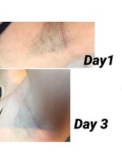 Laser Hair Removal - Transformations