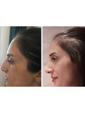 Non-Surgical Nose Job - Fresh Aesthetics Solihull