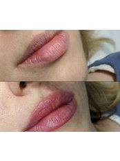 Lip Filler - Surgicare Aesthetics Birmingham