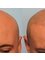 Laser Skin Clinics - Scalp Micropigmentation Before and After 