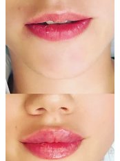 Lip Augmentation - HK Aesthetics