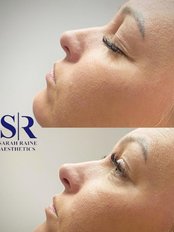 Non-Surgical Nose Job - SR Aesthetics