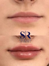 Lip Augmentation - SR Aesthetics