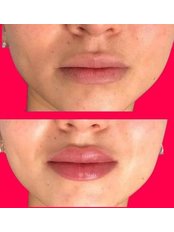 Lip Augmentation - Cole Aesthetics Clinic