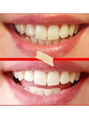 Teeth Whitening- Express Teeth Whitening - Cole Aesthetics Clinic