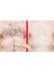 Laser Hair Removal - Cole Aesthetics Clinic
