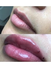 Lip Augmentation - KDJ Aesthetics