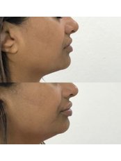 Lip Augmentation - M.K.S Aesthetics Clinic
