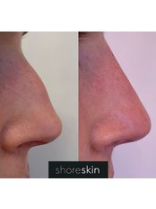 Non-Surgical Nose Job - Shoreskin