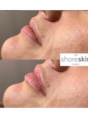 Lip Augmentation - Shoreskin
