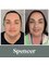 Spencer Aesthetics and Medical Clinic - Full facial rejuvenation 