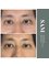 Spencer Aesthetics and Medical Clinic - Sunekos under eye 