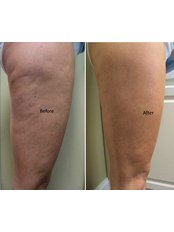 Cellulite Treatment - Sussex Laser Lipo