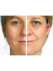 Non-Surgical Facelift - Sussex Laser Lipo