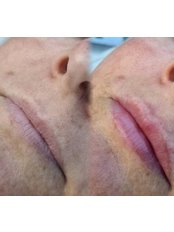 Lip Augmentation - DermaDays Aesthetics