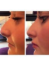 Non-Surgical Nose Job - Envy Beauty Studios Bingley