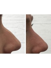 Non-Surgical Rhinoplasty - Derma Space