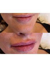 Lip Augmentation - Dr. Jaskaren