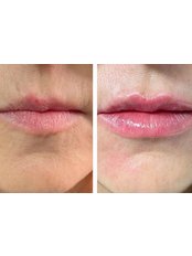 Lip Augmentation - Medifine Aesthetics