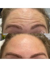 Treatment for Wrinkles - Claire Lavery Aesthetics