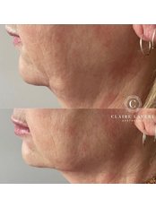 Dermal Fillers - Claire Lavery Aesthetics