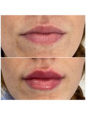 Lip Augmentation - Claire Lavery Aesthetics