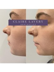 Chin or Jawline Augmentation - Claire Lavery Aesthetics