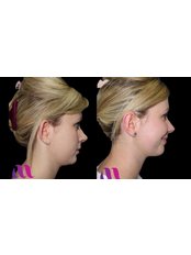 Ear Pinning - Evolve Medical