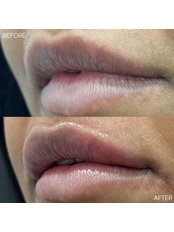 Lip Augmentation - Evolve Medical