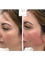 Jaw Contouring - Aesthetica Medical