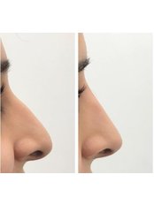 Non-Surgical Nose Job - Aesthetica Medical