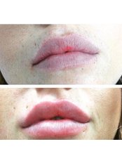 Lip Augmentation - Call Lane Aesthetics