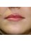 Face Perfect Clinic - Leeds - after lip augmentation 