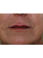 after lip augmentation - Face Perfect Clinic - Leeds