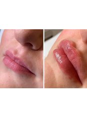 Lip Augmentation - Henah Beauty Leeds