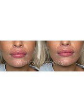 Lip Augmentation - Amica Aesthetics