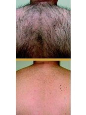 Laser Hair Removal - Manor Health