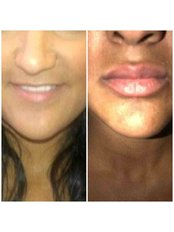 Lip Augmentation - Skin Secrets