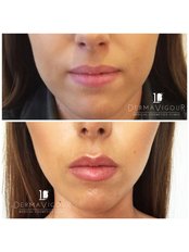 Lip Augmentation - Yorkshire Skin Centre by Dr Raj Thethi