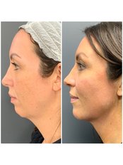 Jaw Contouring - Yorkshire Skin Centre by Dr Raj Thethi