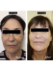 Silhouette Soft Lift - Yorkshire Skin Centre by Dr Raj Thethi