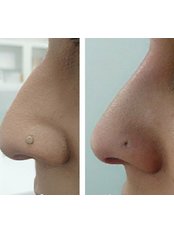 Non-Surgical Nose Job - The Cosmetic Room