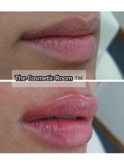 Lip Augmentation - The Cosmetic Room